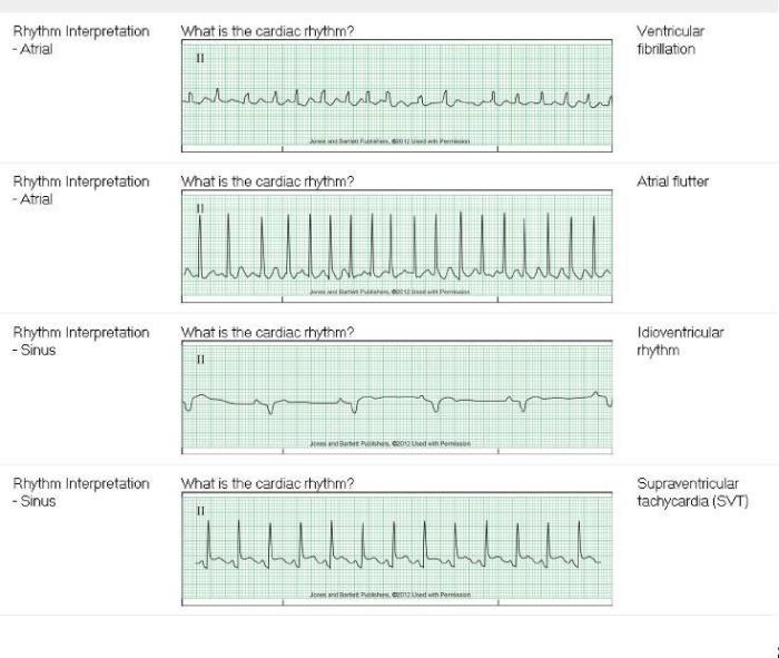 Relias dysrhythmia basic test answers